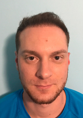 hair transplant photos