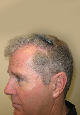 hair transplant photos