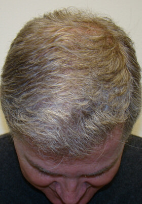 hair transplant photos