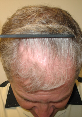 hair transplant photos