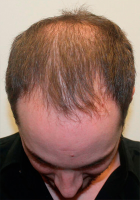 hair transplant before after Photos