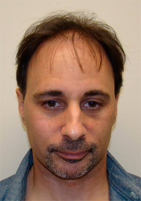 hair transplant photos