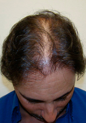 hair transplant before after Photos