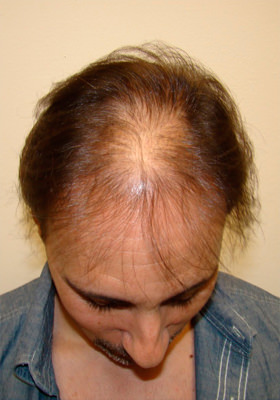 hair transplant photos