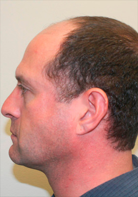 hair transplant photos