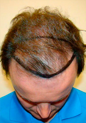 hair transplant before after Photos