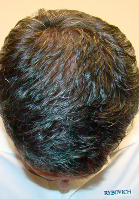 hair transplant before after Photos