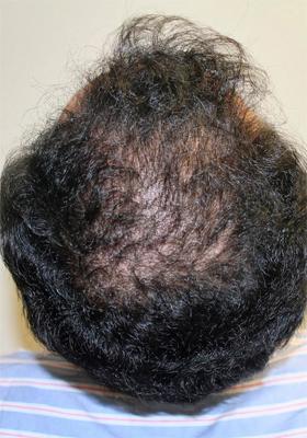 hair transplant before after Photos