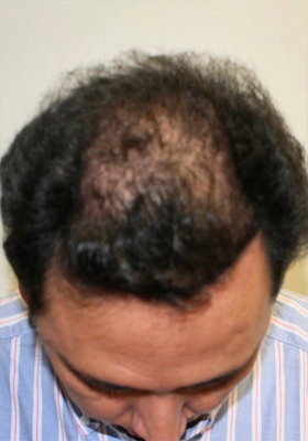 hair transplant photos