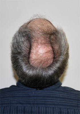 hair transplant photos