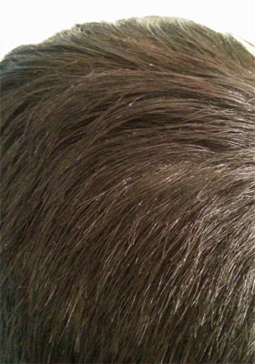 hair transplant photos