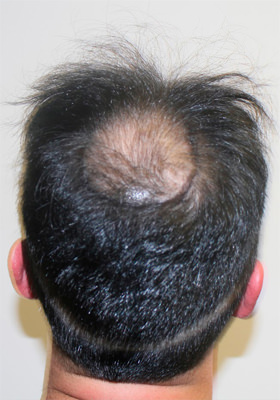 hair transplant photos