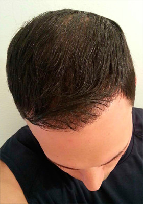 hair transplant before after Photos