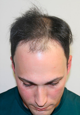 hair transplant photos