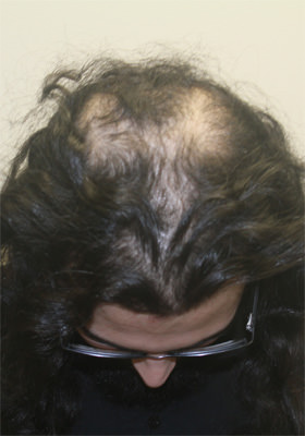 hair transplant before after Photos