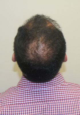 hair transplant before after Photos