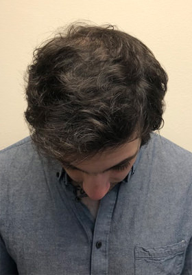 hair transplant before after Photos