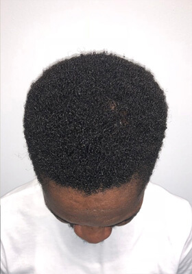 hair transplant before after Photos