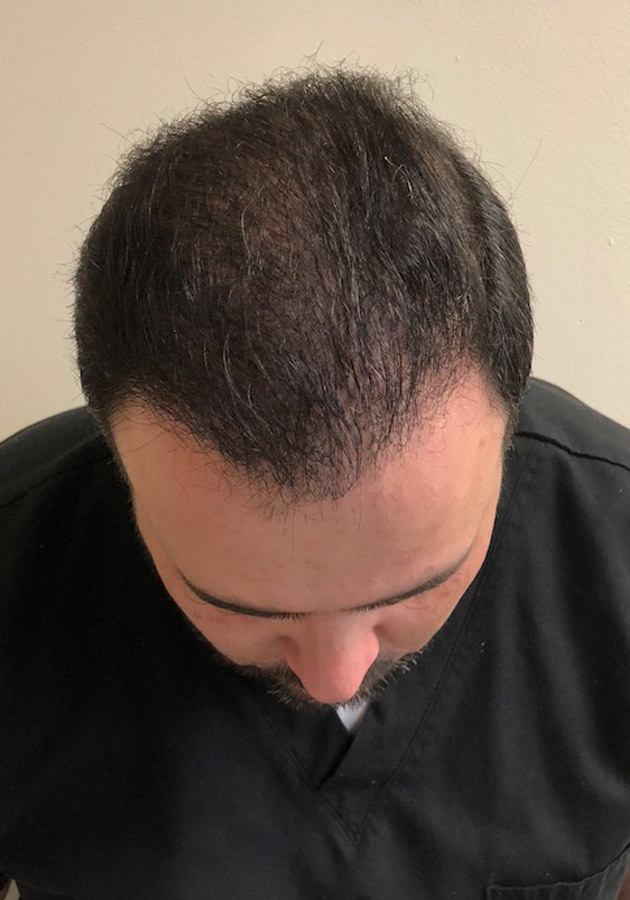 hair transplant before after Photos