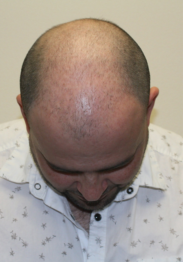 hair transplant before after Photos