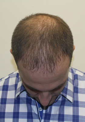 hair transplant before after Photos