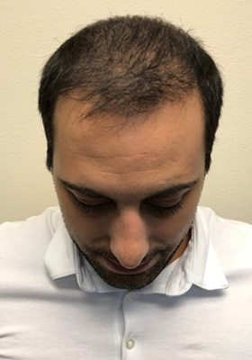 hair transplant before after Photos