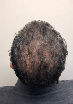 hair transplant photos