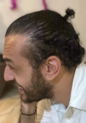 hair transplant before after Photos