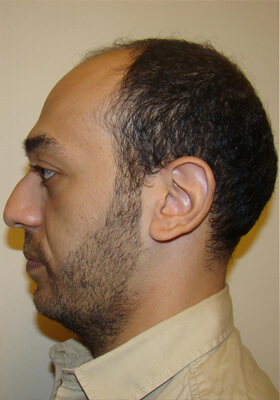 hair transplant before after Photos