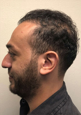 hair transplant photos