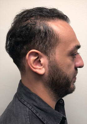 hair transplant photos