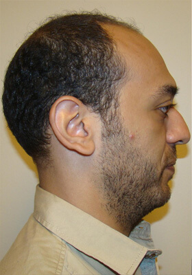 hair transplant photos