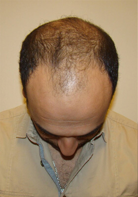 hair transplant photos