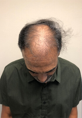 hair transplant before after Photos