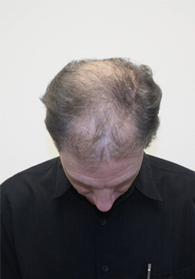 hair transplant before after Photos