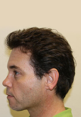 hair transplant photos