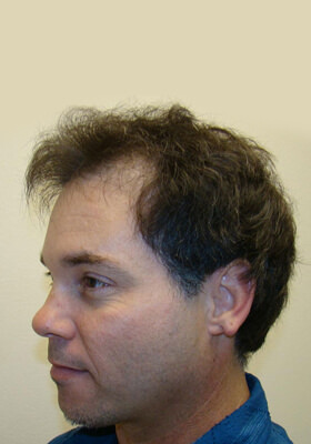 hair transplant photos