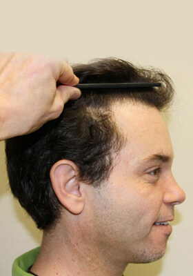 hair transplant photos