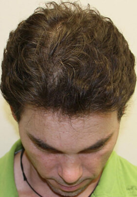 hair transplant photos