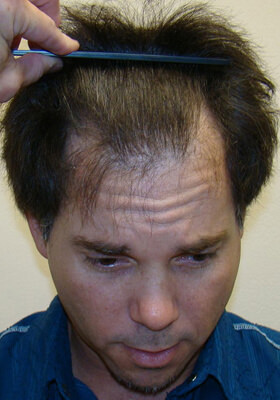 hair transplant photos