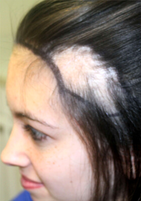 hair transplant photos