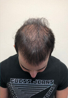 hair transplant before after Photos