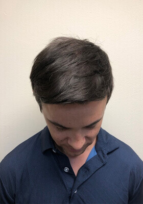 hair transplant before after Photos