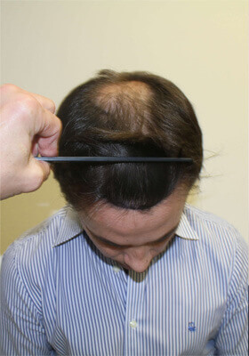 hair transplant before after Photos