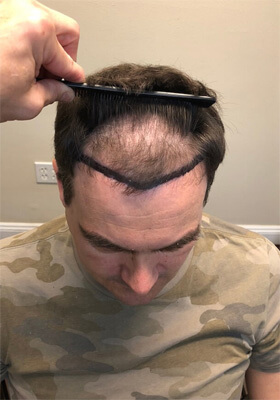 hair transplant before after Photos