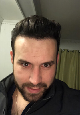 hair transplant before after Photos