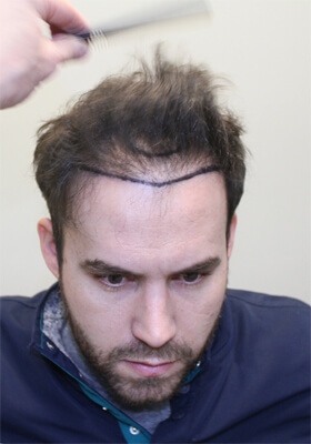 hair transplant before after Photos