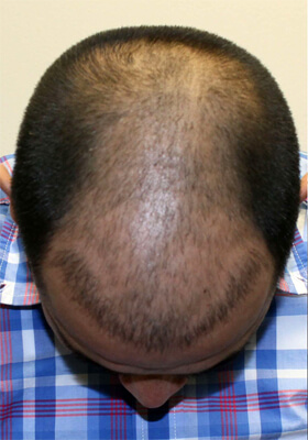 hair transplant before after Photos