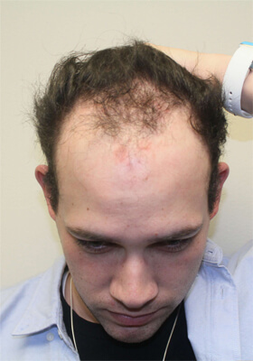 hair transplant before after Photos