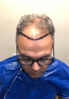 hair transplant before after Photos